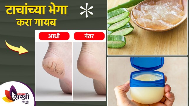 भेगा पडलेल्या टाचांपासून मिळवा सुटका करा हा घरगुती उपाय How to Get Rid of Cracked Heels Permanently
