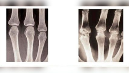 bd-12-de-octubre-dia-mundial-de-la-artritis-121021