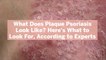 What Does Plaque Psoriasis Look Like? Here's What to Look For, According to Experts