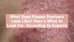 What Does Plaque Psoriasis Look Like? Here's What to Look For, According to Experts
