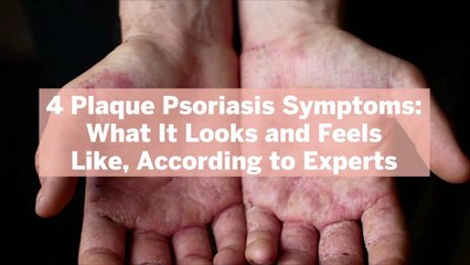 Download Video: 4 Plaque Psoriasis Symptoms: What It Looks and Feels Like, According to Experts