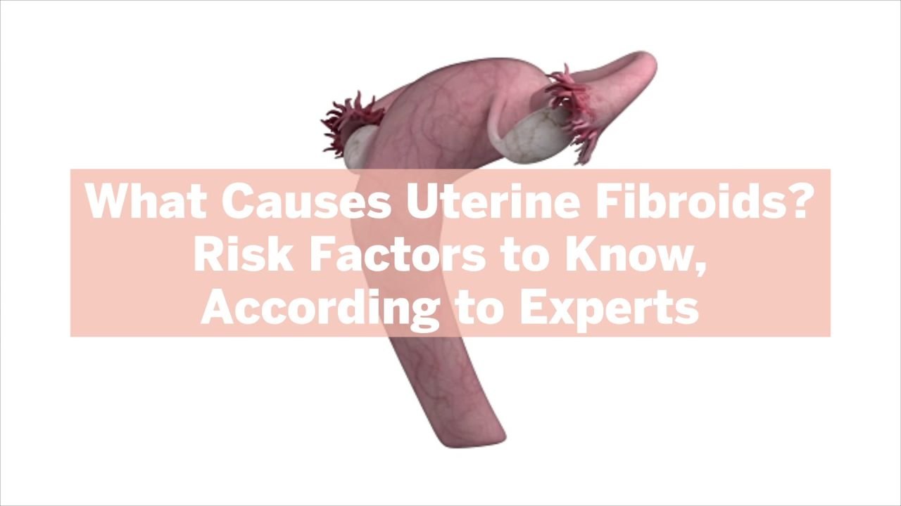What Causes Uterine Fibroids? 5 Risk Factors to Know, According to Experts