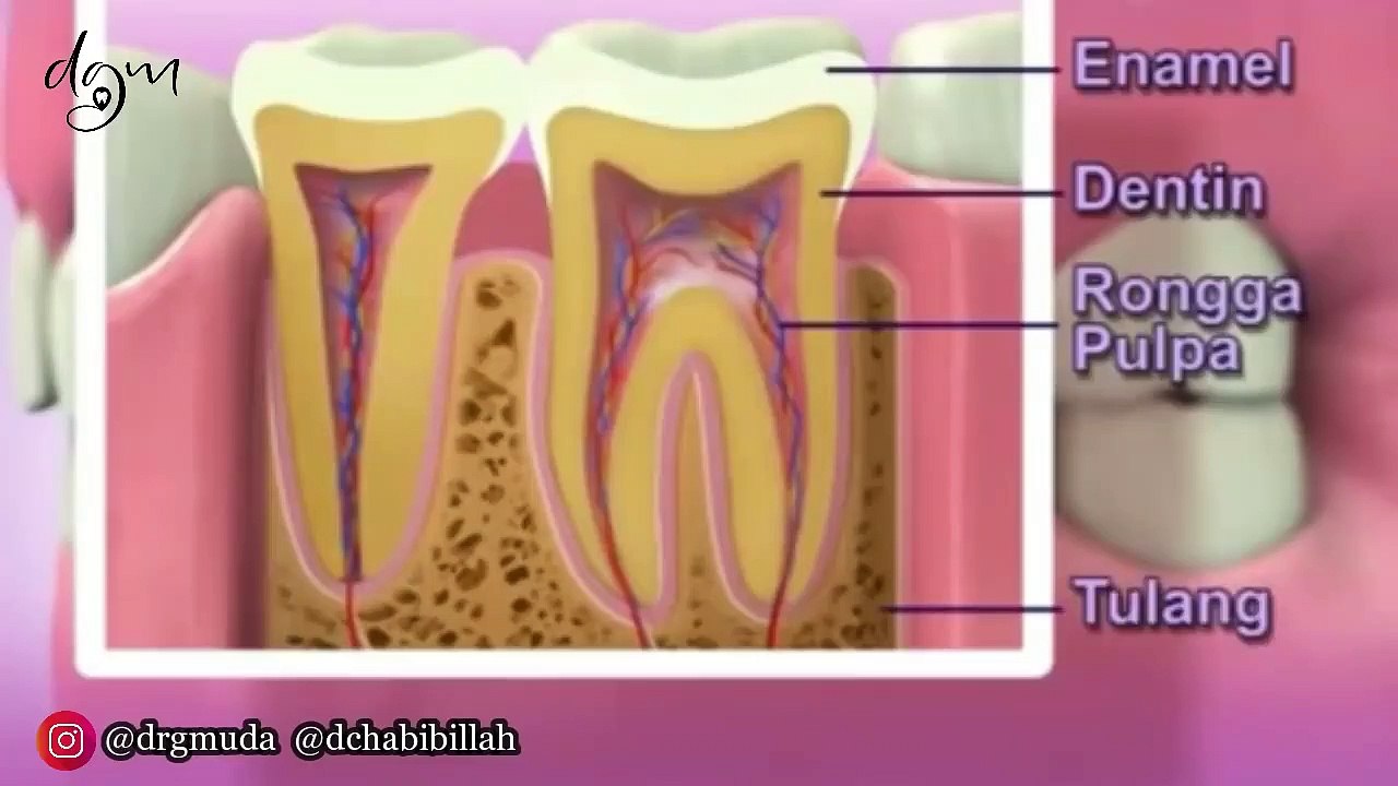Bukan DICABUT‼️Bukan DITAMBAL‼️ Ini Solusi Gigi Berlubang Sakit