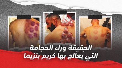 الحقيقة وراء الحجامة التي يُعالج بها كريم بنزيما