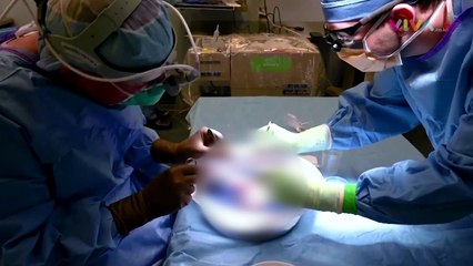 Pertama kali, Ginjal Babi Ditransplantasi ke Manusia