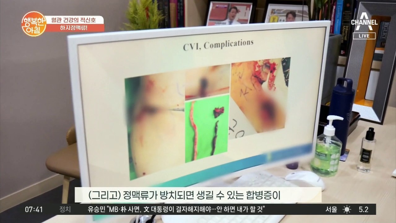 혈관 건강을 위협하는 하지정맥류, 방치하면 생기는 합병증