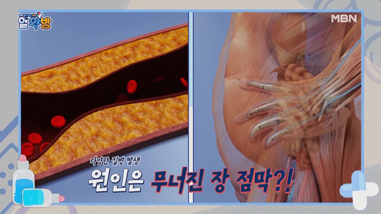 알약방 70회 [전신 건강까지 위협하는 장 질환! 원인은 무너진 장 점막?!]