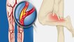 लगातार पैरों में दर्द Hyperlipidemia के Symptoms, Body पर जानलेवा Effect | Boldsky