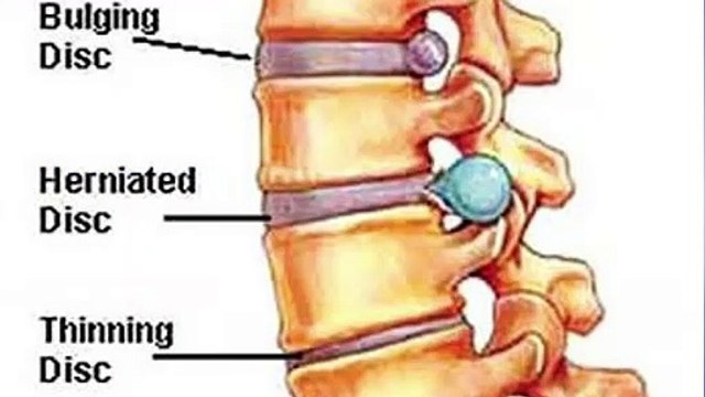 Daily Exercise for Back Pain | Sciatica Pain Relief Exercises | Sciatica | Slip-Disc
