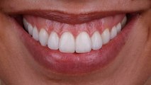 Você tem sorriso gengival e deseja reduzí-lo? Odontólogo Felipe Vieira explica como fazer