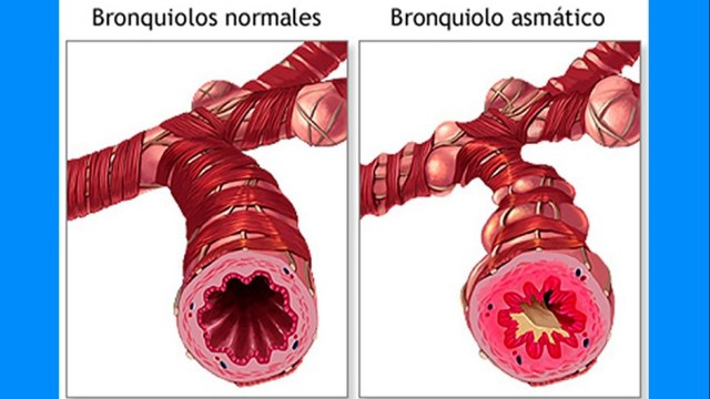 bd-abordaje-adecuado-del-asma-y-opciones-de-tratamientos-281021
