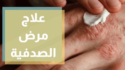 الصدفية أعراضها وتشخيصها وطرق علاجها