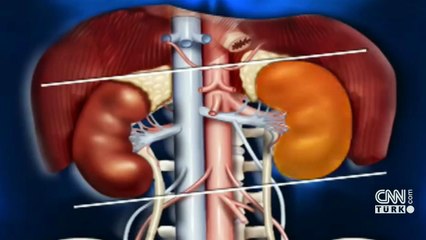 "Böbrek taşı" nasıl anlaşılır?