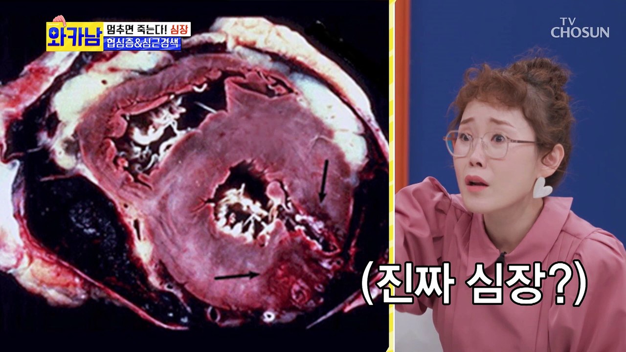 심장 질환 중 돌연사 원인 1위.. ‘협심증&심근경색’ 대표증상은? TV CHOSUN 211102 방송