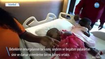 Kamerunlu Yapışık İkizler İstanbul’da Ayrıldı