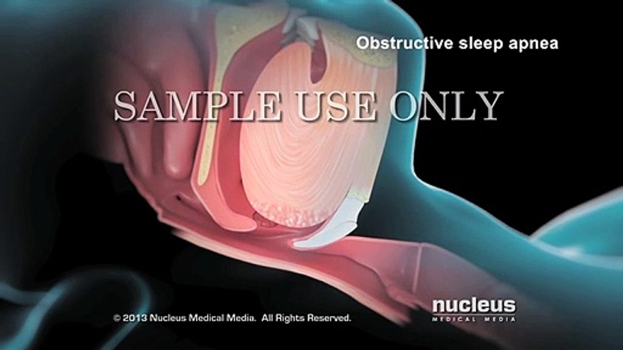 Nucleus - Sleep Apnea