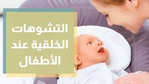 التشوهات الخلقية عند الأطفال