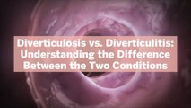 Diverticulosis vs. Diverticulitis: Understanding the Difference Between the Two Conditions