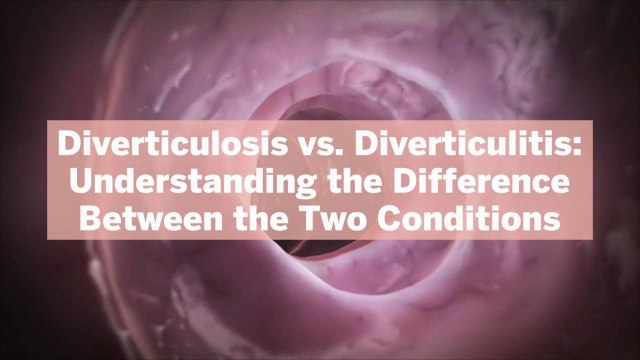 Diverticulosis vs. Diverticulitis: Understanding the Difference Between the Two Conditions