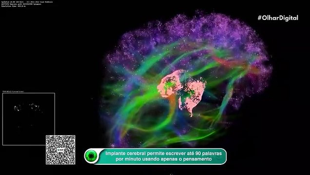 Implante cerebral permite escrever até 90 palavras por minuto usando apenas o pensamento