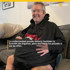 Tiene enormes riñones de más de 40 kg ,será sometido a una cirugía