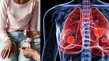 Diabetes Patients में Lung Cancer का खतरा ज्यादा, Symptoms नजरअंदाज करना खतरनाक | Boldsky