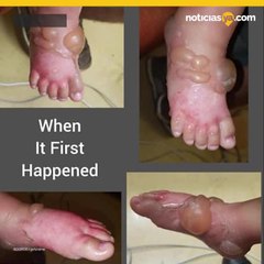 Sumerge los pies de su nieta en agua hirviendo porque tuvo un mal da