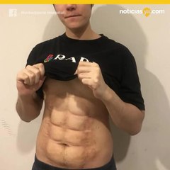 Esta ciruga promete abdominales perfectas en poco tiempo y sin dolor