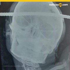 Una barra de hierro le atravesó el cráneo y sobrevivió milagrosamente