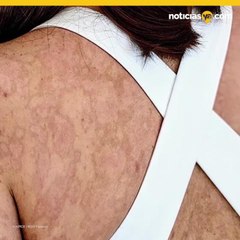 FOTO: Reacción alérgica a la penicilina hizo que su piel se desprendiera