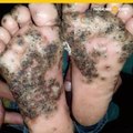 Niña contrajo espantosa infección en los pies después de jugar en el lodo