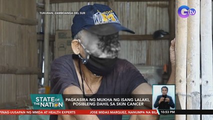 Pagkasira ng mukha ng isang lalaki, posibleng dahil sa skin cancer | SONA