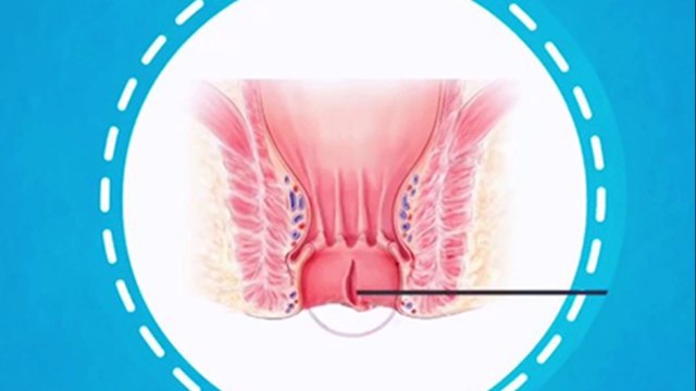 bd-hablamos-sobre-diagnostico-y-tratamiento-de-hemorroides-161121