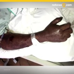 Fue a pescar cangrejos pero regresó con una terrible infección mortal