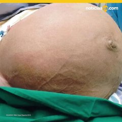 Le extirparon un tumor gigante de 61 libras que crecía en su vientre