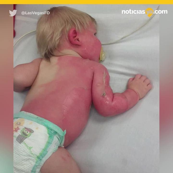 bebe quemado