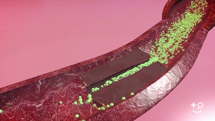 Diabetes  - What Is Diabetic Heart Disease?