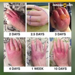 Planta venenosa encontrada en Virginia causa ceguera y quemaduras