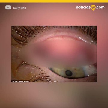 Casi pierde la vista al pasar 25 años sin desmaquillar sus ojos