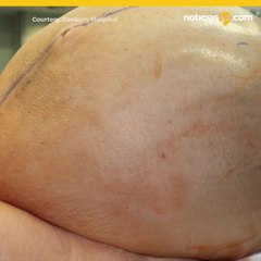 Mujer de Connecticut tenía tumor de 132 libras en ovario