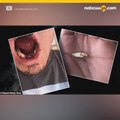 Le explota cigarro electrónico mientras fumaba y pierde cuatro dientes