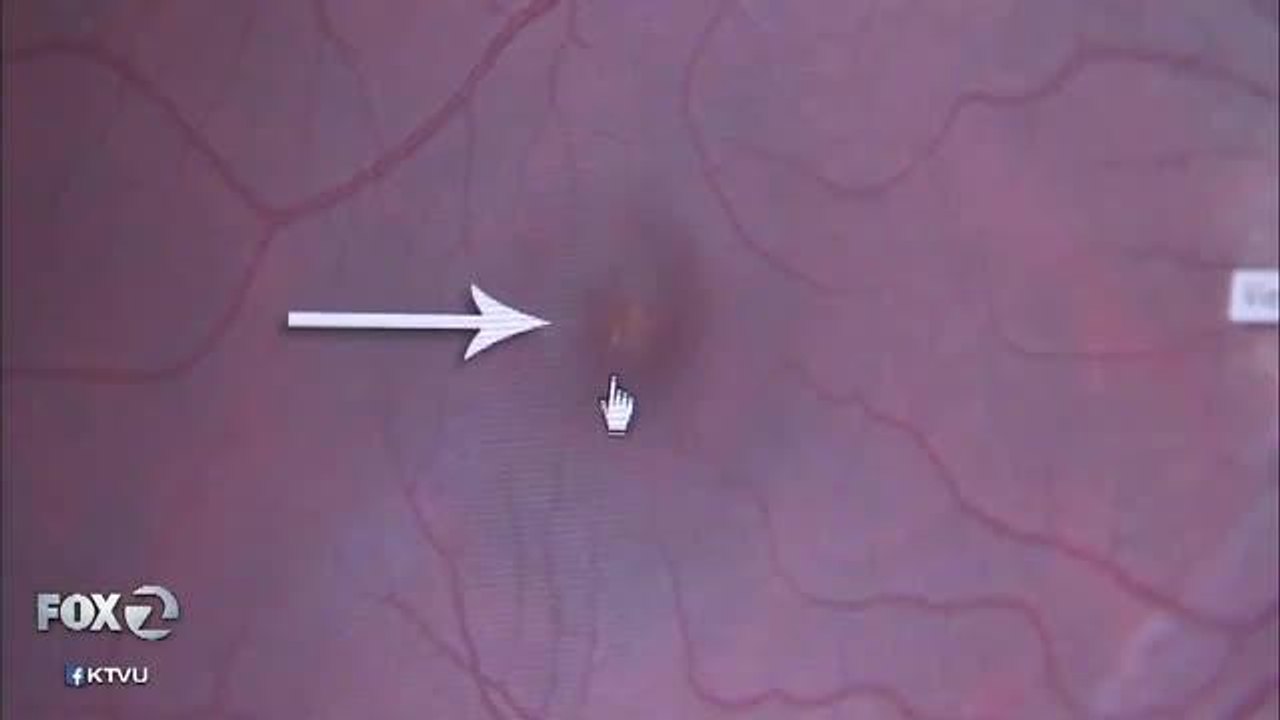 Thousands may be experiencing eye problems after eclipse - Story  KTVU