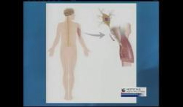 Esclerosis lateral amiotrófica (ALS)