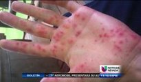 Enfermedad contagiosa en las guarderias de Washoe