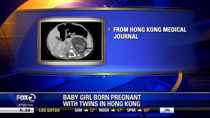Baby Girl Born Pregnant With Twins In Hong Kong