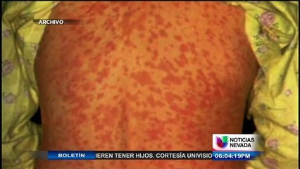 Confirman otro caso de sarampión