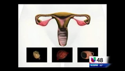 Por Su Salud: Cáncer De Ovario