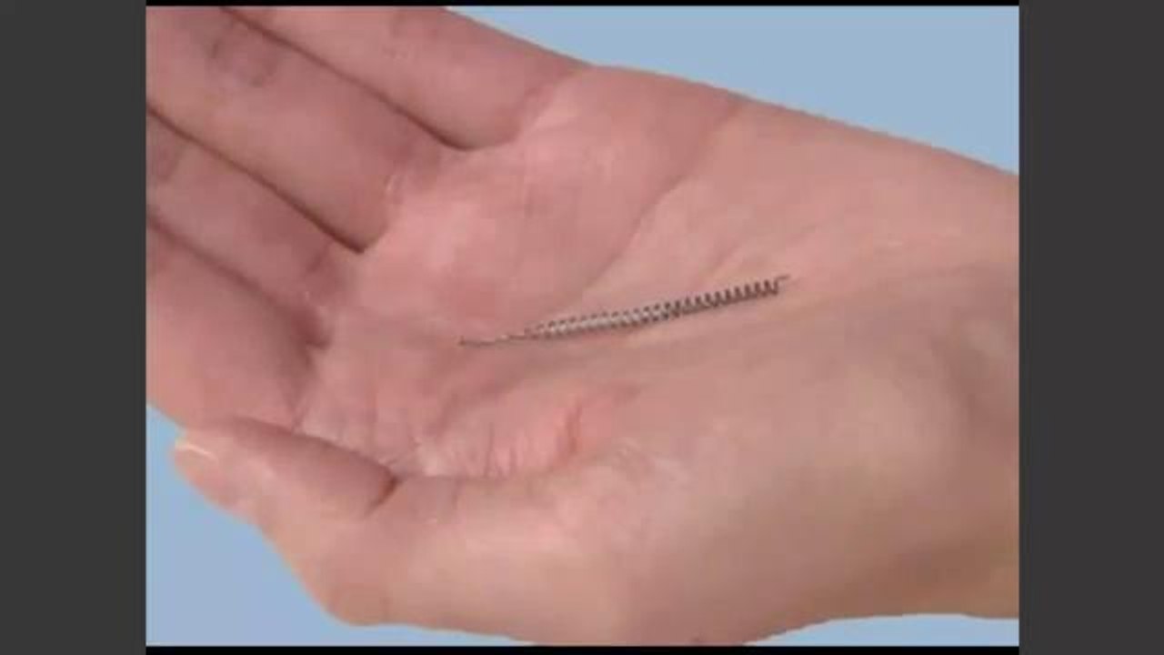 Mujeres locales reportan efectos dañinos de implante anticonceptivo