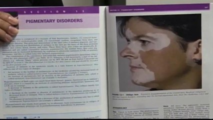 Posible tratamiento para el Vitiligo