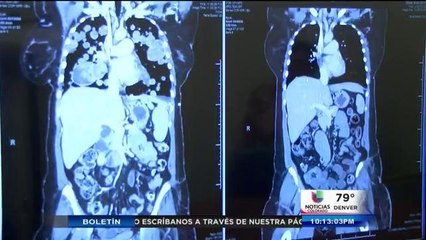 Terapia contra el cáncer da resultados alentadores